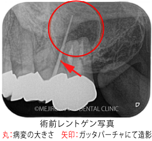 目白マリア歯科｜【症例】歯根端切除術（意図的再植術）により、病変の大きい根尖性歯周炎の抜歯を回避｜治療前_術前レントゲン写真3（印あり）-1-1