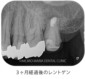 目白マリア歯科｜【症例】歯根端切除術（意図的再植術）により、病変の大きい根尖性歯周炎の抜歯を回避｜治療後_歯根端切除術（意図的再移植術）3ヶ月経過後のレントゲン