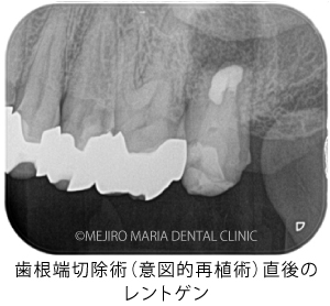 目白マリア歯科｜【症例】歯根端切除術（意図的再植術）により、病変の大きい根尖性歯周炎の抜歯を回避｜治療後_歯根端切除術（意図的再移植術）直後のレントゲン画像