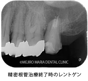 目白マリア歯科｜【症例】歯根端切除術（意図的再植術）により、病変の大きい根尖性歯周炎の抜歯を回避｜治療詳細_精密根管治療終了時のレントゲン画像