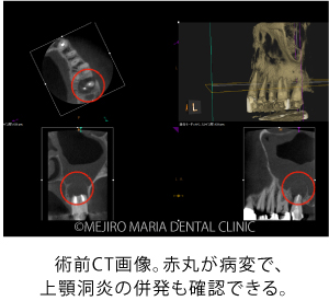 目白マリア歯科｜【症例】歯根端切除術（意図的再植術）により、病変の大きい根尖性歯周炎の抜歯を回避｜治療詳細_術前-CT画像