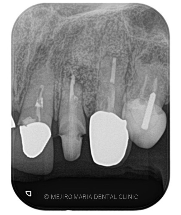 目白マリア歯科【症例】根尖部に充填された人工骨の感染により根尖性歯周炎が難治化。歯内療法（精密根管治療）でのリカバリー_該当歯牙の精密根管治療後のレントゲン画像