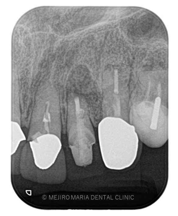 目白マリア歯科【症例】根尖部に充填された人工骨の感染により根尖性歯周炎が難治化。歯内療法（精密根管治療）でのリカバリー_歯根端切除術直後のレントゲン画像