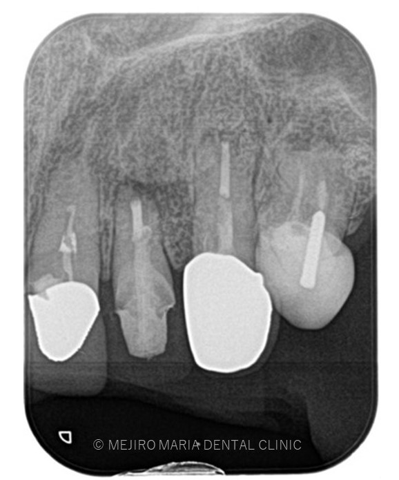 目白マリア歯科【症例】根尖部に充填された人工骨の感染により根尖性歯周炎が難治化。歯内療法（精密根管治療）でのリカバリー_術後３ヶ月後のレントゲン画像