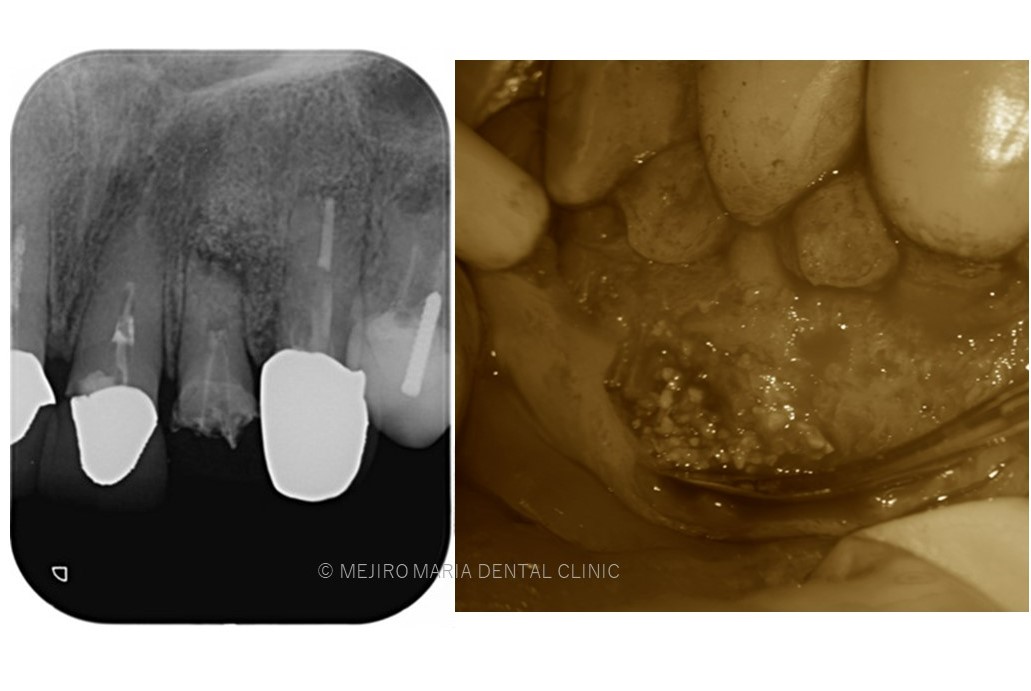 目白マリア歯科【症例】根尖部に充填された人工骨の感染により根尖性歯周炎が難治化。歯内療法（精密根管治療）でのリカバリー_治療前の口腔内画像と感染した人工骨の画像