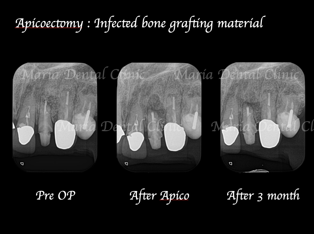 目白マリア歯科【症例】根尖部に充填された人工骨の感染により根尖性歯周炎が難治化。歯内療法（精密根管治療）でのリカバリー治療前治療後の画像
