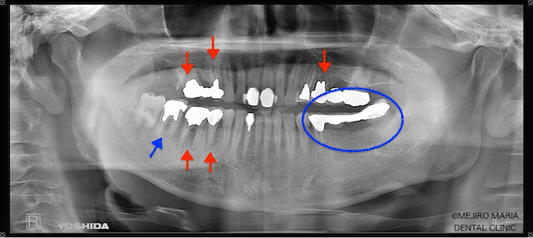 目白マリア歯科|【症例】チーム医療で行った全顎的な治療：精密根管治療による歯の保存と咬合崩壊を防ぐインプラント治療｜歯のレントゲン画像_治療詳細4
