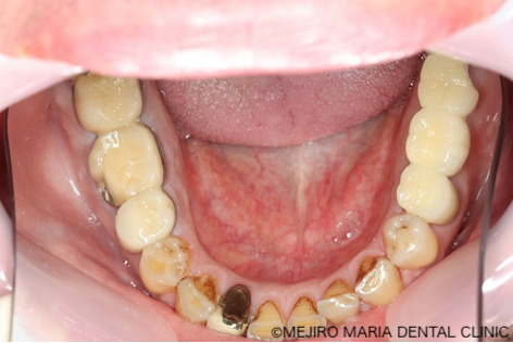 目白マリア歯科【症例】チーム医療で行った全顎的な治療：精密根管治療による歯の保存と咬合崩壊を防ぐインプラント治療｜治療前の下部の歯の画像_治療前3-1