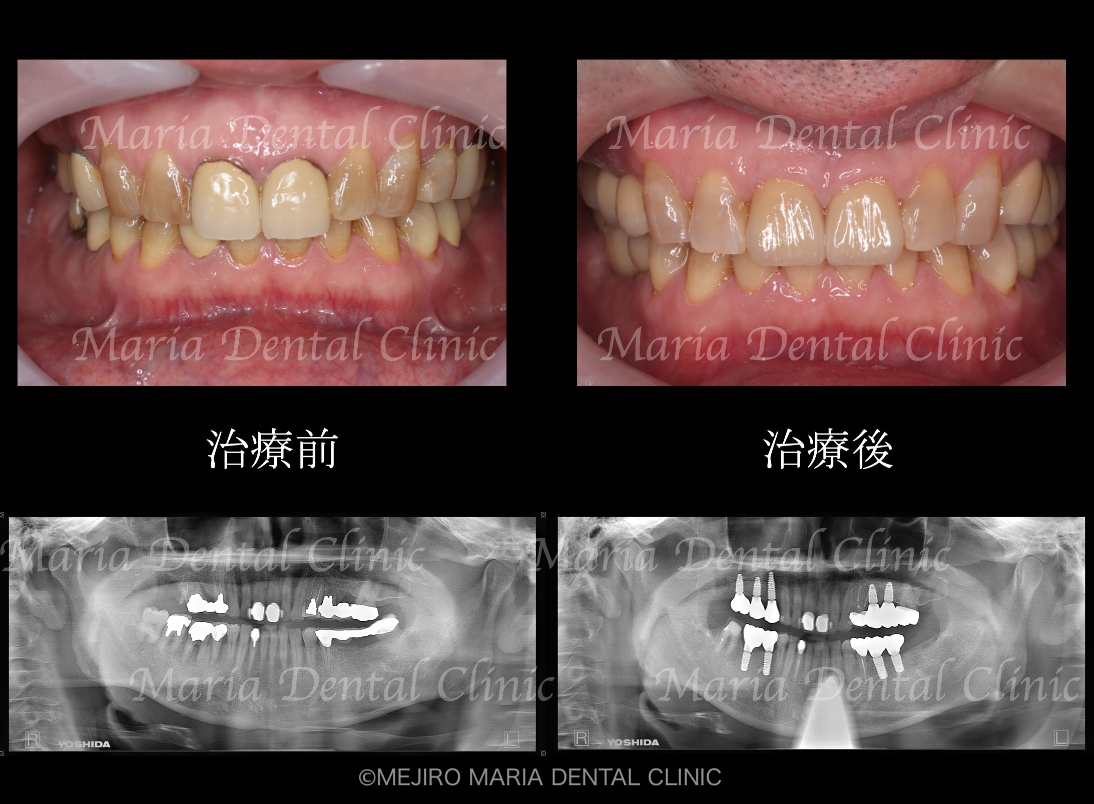 目白マリア歯科【症例】チーム医療で行った全顎的な治療：精密根管治療による歯の保存と咬合崩壊を防ぐインプラント治療｜治療前後の歯の比較画像_メイン2-1