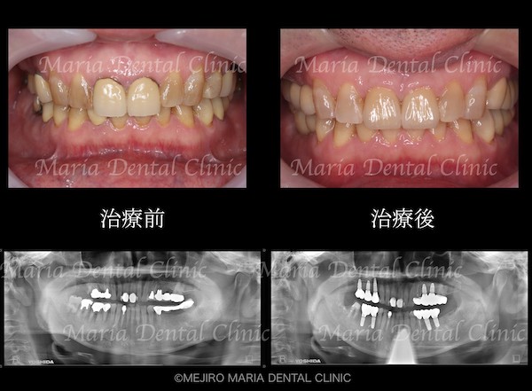 目白マリア歯科|【症例】チーム医療で行った全顎的な治療：精密根管治療による歯の保存と咬合崩壊を防ぐインプラント治療｜治療前後の歯の比較画像_メイン2