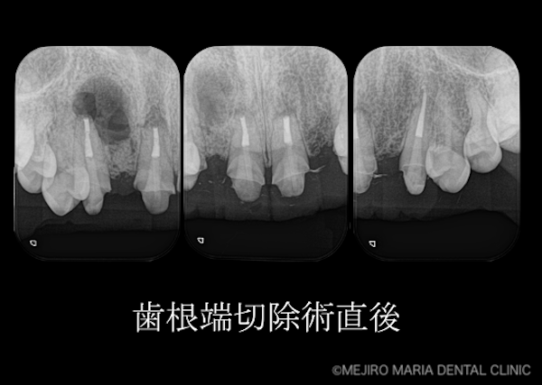 目白マリア歯科｜【症例】・根管治療だけでは治癒に至らない歯を歯根端切除術で保存｜歯根端切除術直後のレントゲン画像｜治療詳細2