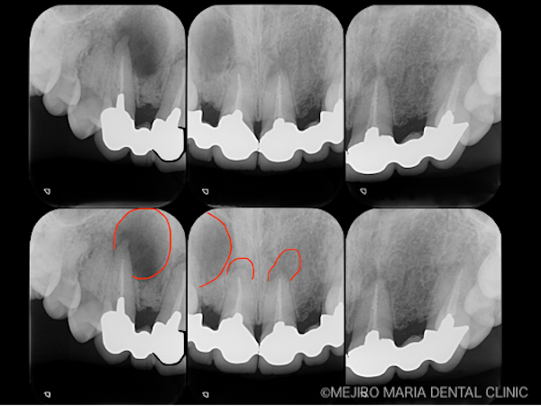 目白マリア歯科｜【症例】・根管治療だけでは治癒に至らない歯を歯根端切除術で保存｜治療前のレントゲン画像｜治療前1