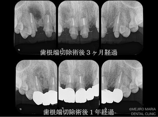 目白マリア歯科｜【症例】・根管治療だけでは治癒に至らない歯を歯根端切除術で保存｜治療後3ヶ月と1年経過後のレントゲン画像｜治療後1