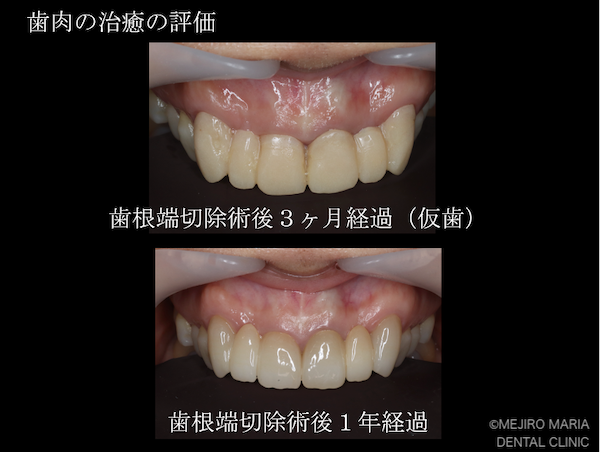 目白マリア歯科｜【症例】・根管治療だけでは治癒に至らない歯を歯根端切除術で保存｜治療後3ヶ月と1年経過後の歯肉の比較画像｜治療後2