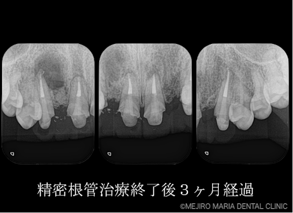 目白マリア歯科｜【症例】・根管治療だけでは治癒に至らない歯を歯根端切除術で保存｜治療後3ヶ月経過後のレントゲン画像｜治療詳細1