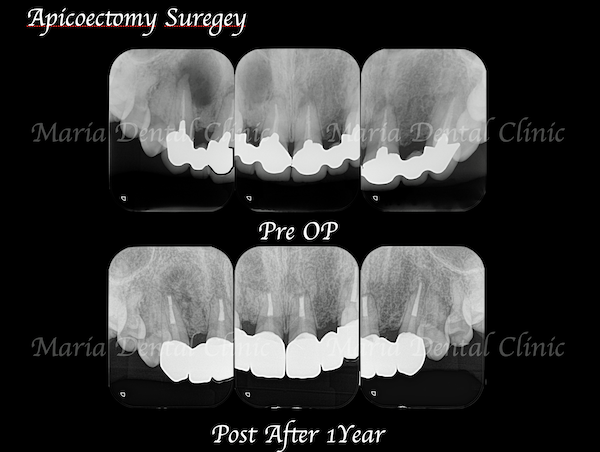 目白マリア歯科｜【症例】・根管治療だけでは治癒に至らない歯を歯根端切除術で保存｜術前後の比較｜メイン画像｜