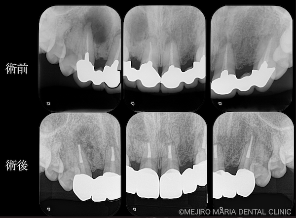 目白マリア歯科｜【症例】・根管治療だけでは治癒に至らない歯を歯根端切除術で保存｜術前後の比較｜メイン画像｜