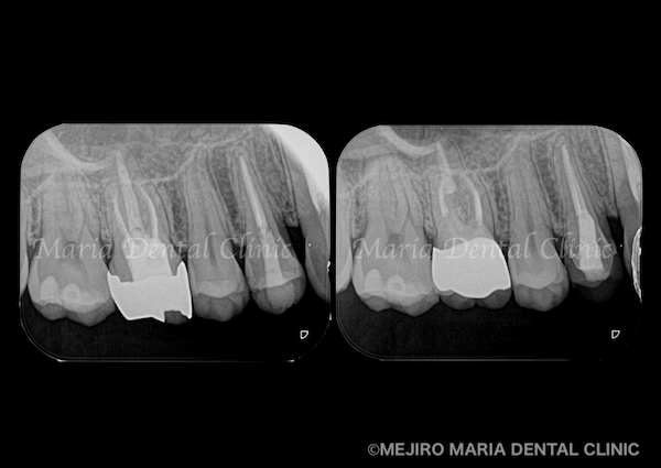 目白マリア歯科｜【症例】歯性上顎洞炎（蓄膿症）を併発した根尖性歯周炎を、精密根管治療で治癒｜歯のレントゲン画像_メイン