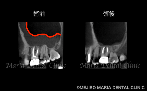 目白マリア歯科｜【症例】歯性上顎洞炎（蓄膿症）を併発した根尖性歯周炎を、精密根管治療で治癒｜治療前後の歯のCT比較画像_治療後2