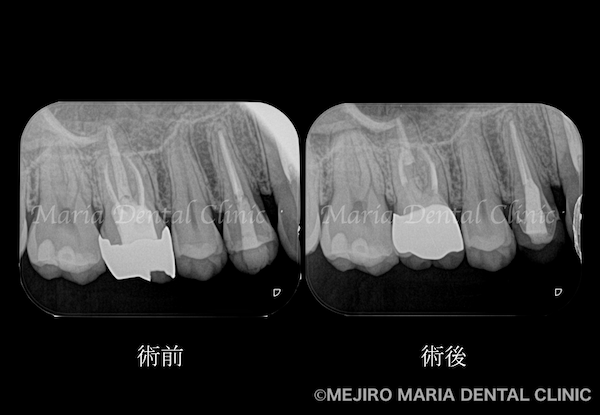 目白マリア歯科｜【症例】歯性上顎洞炎（蓄膿症）を併発した根尖性歯周炎を、精密根管治療で治癒｜治療前後の歯のレントゲン比較画像_治療後1.