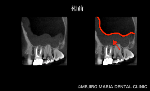 目白マリア歯科｜【症例】歯性上顎洞炎（蓄膿症）を併発した根尖性歯周炎を、精密根管治療で治癒｜術前の歯のCT画像_治療前1