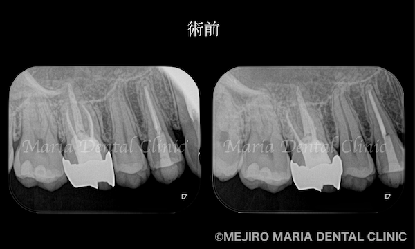 目白マリア歯科｜【症例】歯性上顎洞炎（蓄膿症）を併発した根尖性歯周炎を、精密根管治療で治癒｜術前の歯のレントゲン画像_治療前1