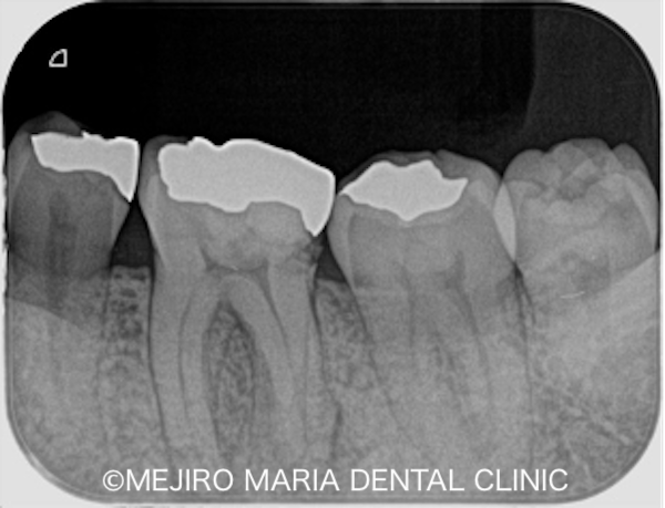 目白マリア歯科｜院長ブログ｜症例｜【症例】コンセプトを守った初回根管治療（精密根管治療）で治癒｜治療前のレントゲン画像_治療前3