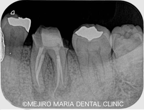 目白マリア歯科｜院長ブログ｜症例｜【症例】コンセプトを守った初回根管治療（精密根管治療）で治癒｜治療後の歯のレントゲン画像_治療後9