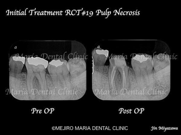 目白マリア歯科｜院長ブログ｜症例｜【症例】無症状で進行する虫歯・原因不明の歯肉の腫れを、コンセプトを守った初回根管治療（精密根管治療）で治癒｜メイン比較画像-1