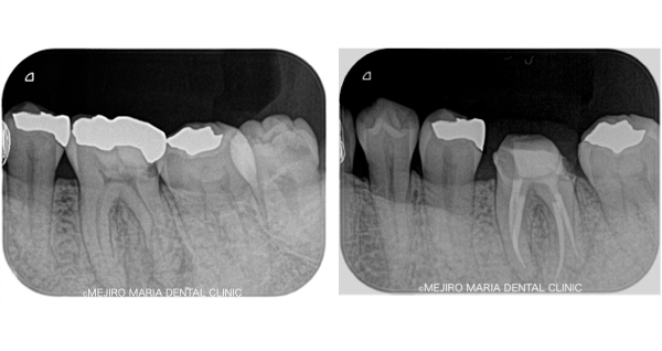 目白マリア歯科｜院長ブログ｜症例｜【症例】無症状で進行する虫歯・原因不明の歯肉の腫れを、コンセプトを守った初回根管治療（精密根管治療）で治癒｜メイン比較画像2