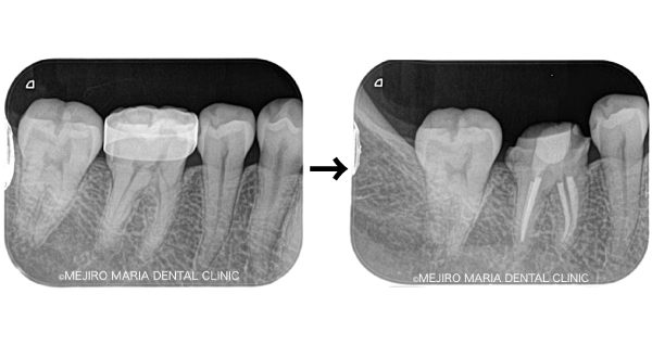目白マリア歯科｜ブログ｜症例｜原因不明の歯の痛みを、確実な診査診断で解決（クラックトゥース編）｜メイン1