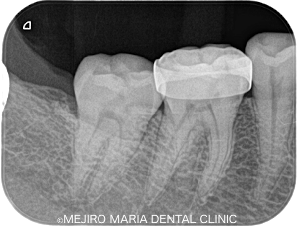 目白マリア歯科｜ブログ｜症例｜原因不明の歯の痛みを、確実な診査診断で解決（クラックトゥース編）｜治療前レントゲン画像6