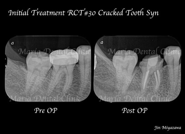 目白マリア歯科｜ブログ｜症例｜原因不明の歯の痛みを、確実な診査診断で解決（クラックトゥース編）｜治療前治療後画像