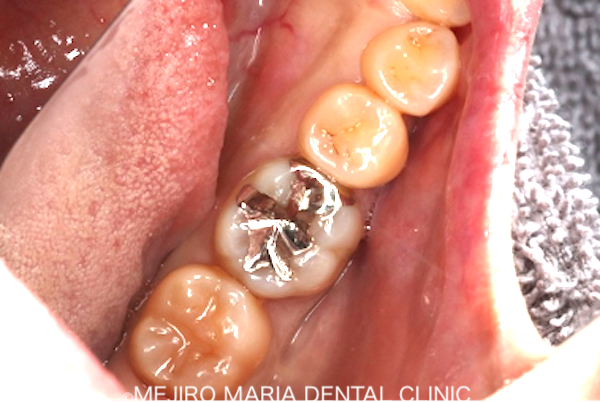 目白マリア歯科｜ブログ｜症例｜原因不明の歯の痛みを、確実な診査診断で解決（クラックトゥース編）｜治療前画像3