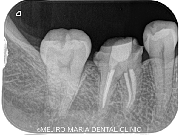 目白マリア歯科｜ブログ｜症例｜原因不明の歯の痛みを、確実な診査診断で解決（クラックトゥース編）｜治療後レントゲン画像7