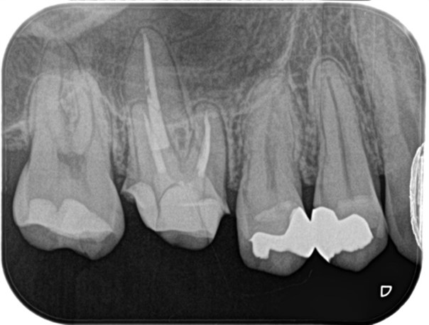 【症例】虫歯治療後の痛み、精密根管治療（抜髄）_治療後のレントゲン画像｜目白マリア歯科