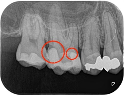 【症例】虫歯治療後の痛み、精密根管治療（抜髄）_術前のレントゲン画像、虫歯処置の箇所マーク｜目白マリア歯科