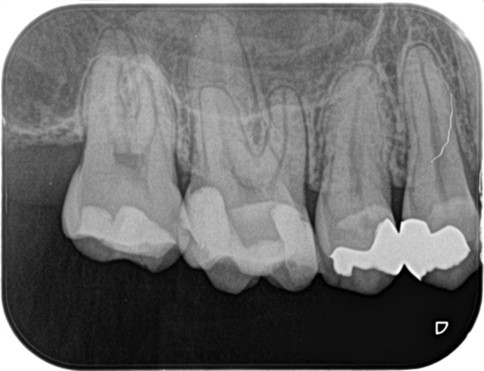 【症例】虫歯治療後の痛み、精密根管治療（抜髄）_術前のレントゲン画像｜目白マリア歯科