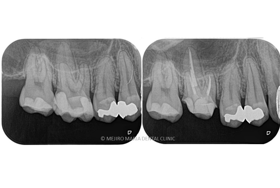 【症例】虫歯治療後の痛み、精密根管治療（抜髄）_術前術後の比較メイン画像｜目白マリア歯科