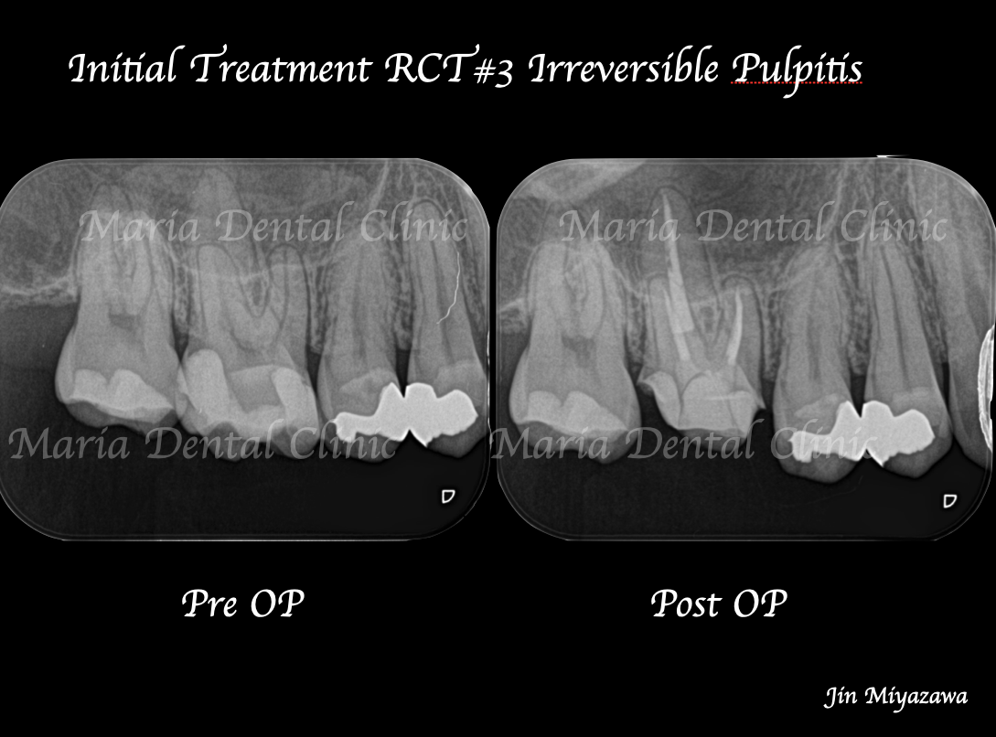 【症例】虫歯治療後の痛み、精密根管治療（抜髄）_術前術後の比較画像｜目白マリア歯科