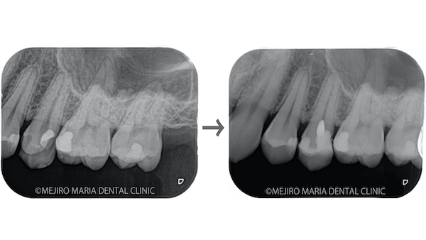 目白マリア歯科_【症例】生活歯髄断髄法（生活歯髄療法）による歯髄保存症例（精密根管治療）術前画像メイン