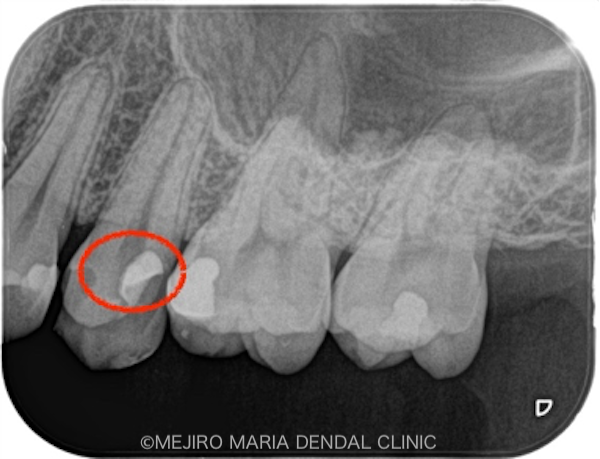 目白マリア歯科|【症例】生活歯髄断髄法（生活歯髄療法）による歯髄保存症例（精密根管治療）_レントゲン_治療前2