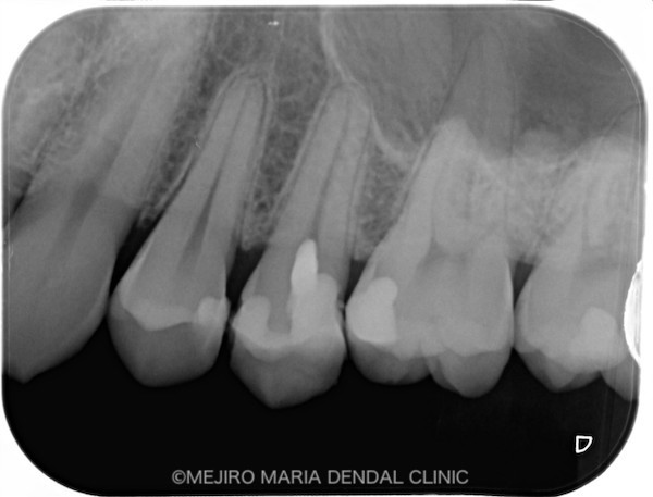 目白マリア歯科|【症例】生活歯髄断髄法（生活歯髄療法）による歯髄保存症例（精密根管治療）_レントゲン_治療後1