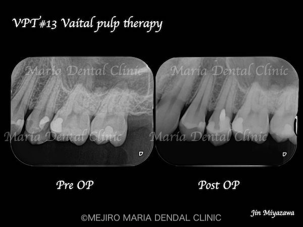 目白マリア歯科_【症例】生活歯髄断髄法（生活歯髄療法）による歯髄保存症例（精密根管治療）術前術後レントゲン画像