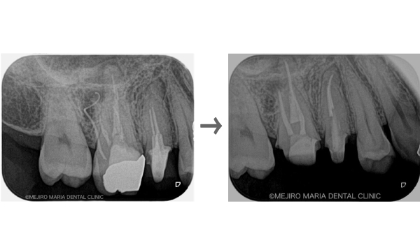 目白マリア歯科｜ブログ｜【症例】コンセプトを守った再根管治療（精密根管治療）｜治療前後の比較画像
