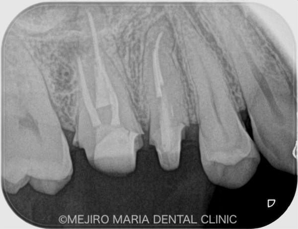 目白マリア歯科｜ブログ｜【症例】コンセプトを守った再根管治療（精密根管治療）｜治療後2