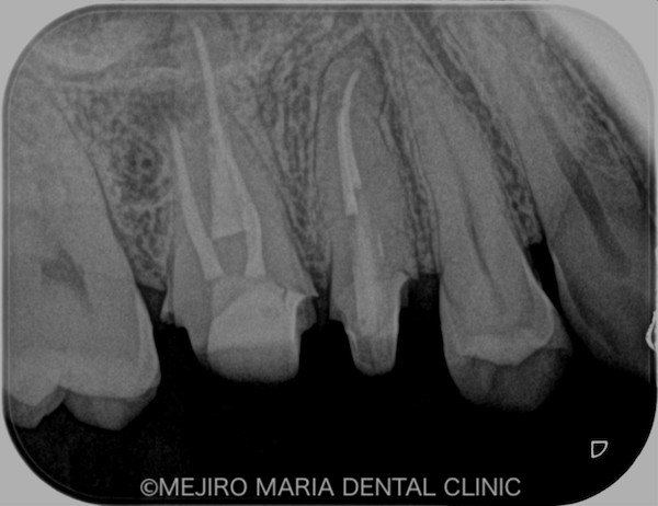 目白マリア歯科｜ブログ｜【症例】コンセプトを守った再根管治療（精密根管治療）｜治療詳細1