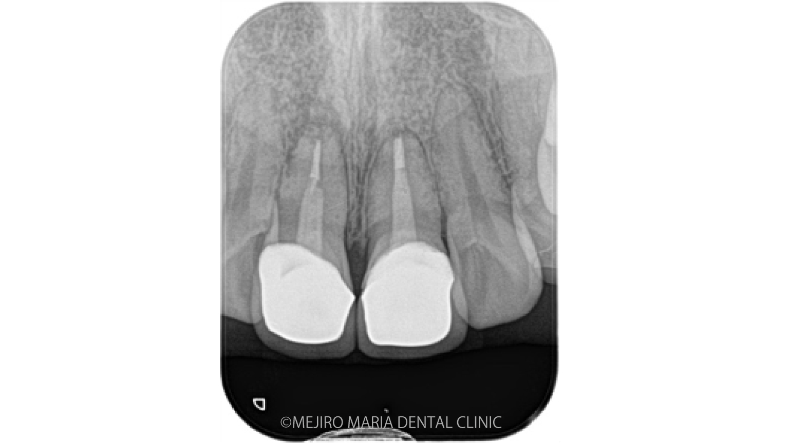 目白マリア歯科｜ブログ｜【症例】歯根端切除術の失敗をリカバリー（歯根端切除術）｜メイン画像