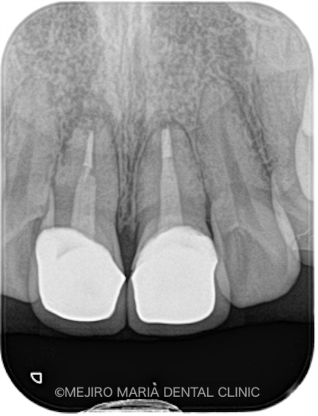 目白マリア歯科｜ブログ｜【症例】歯根端切除術の失敗をリカバリー（歯根端切除術）｜レントゲン画像_治療前3