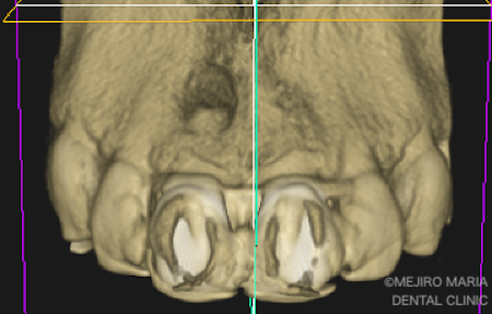目白マリア歯科｜ブログ｜【症例】歯根端切除術の失敗をリカバリー（歯根端切除術）｜歯科用CT_治療前2
